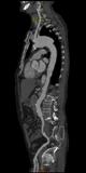 躯幹矢状断造影画像(Sagittal)