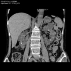 腹部冠状断CT画像(Coronal)