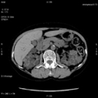 単純腹部CT画像(Axial)