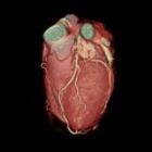 心臓血管3D画像