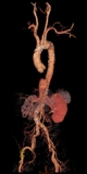 躯幹大血管3D画像