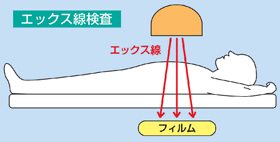 外から放射線をあてる検査