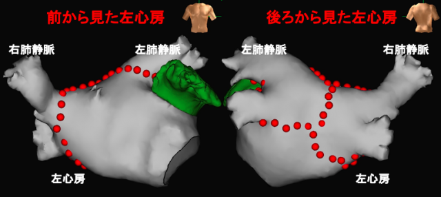 高周波通電での肺静脈隔離ライン