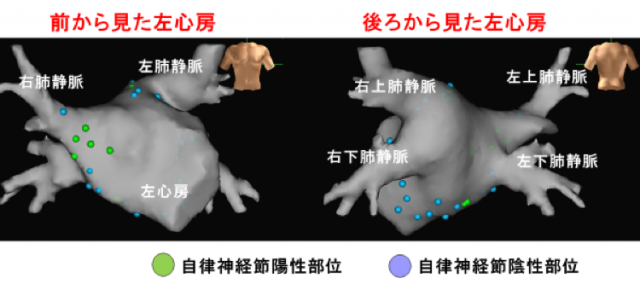 自律神経節マッピング、GP