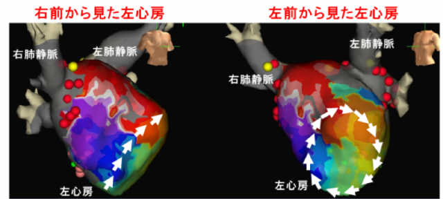 心房頻拍マッピング