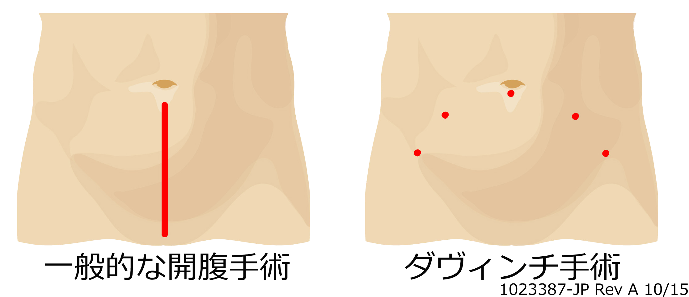 一般手術との創部の比較